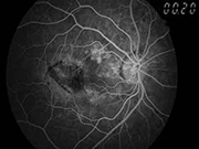 best ffa diagnostic report for the retina