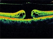 best oct diagnostic report of eye