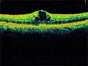 best oct diagnostic report for the retina