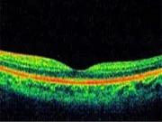 OCT Eye Test in Delhi