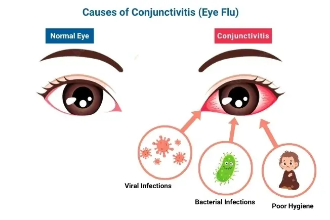 Common Causes of eye flu