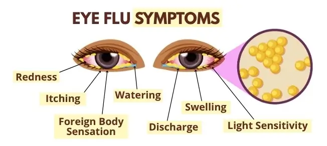 Symptoms of Eye Flu