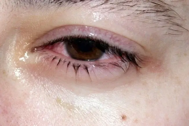 Allergic conjunctivitis
