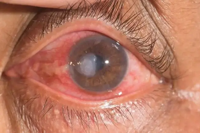 Corneal ulcer