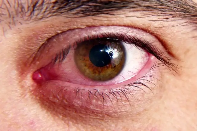 Dry eye disease