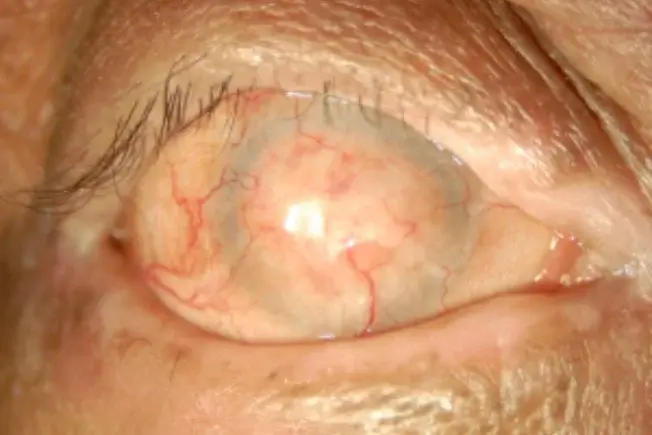 Ocular cicatricial pemphigoid