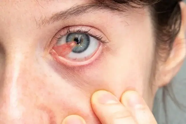 Pterygium
