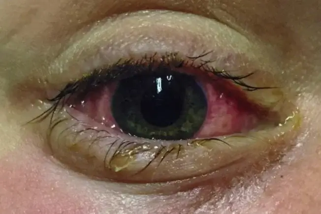 Steven johnson syndrome