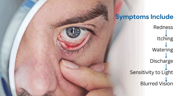 Most Common Symptoms of Viral Conjunctivitis
