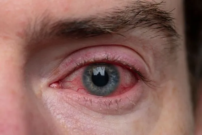 What Is Eye Flu