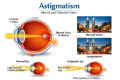 Understanding astigmatism