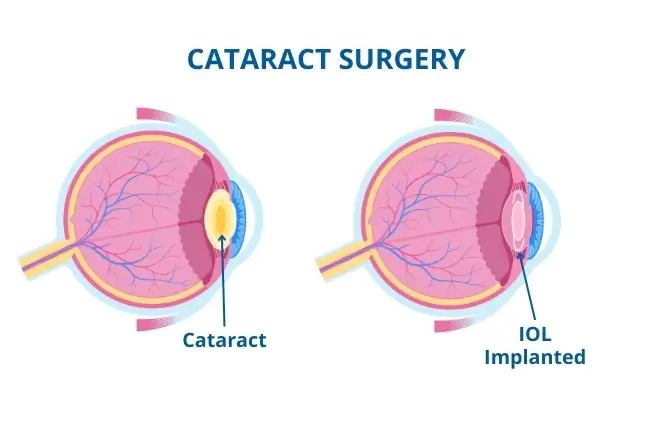 Cataract surgery