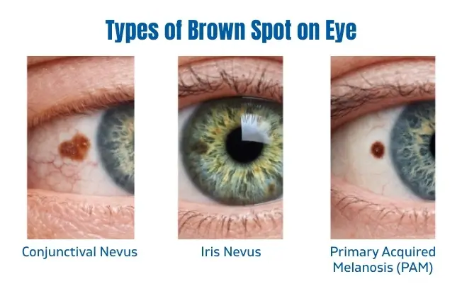 Types of brown spot on eye