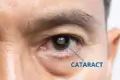 Cataract Eye