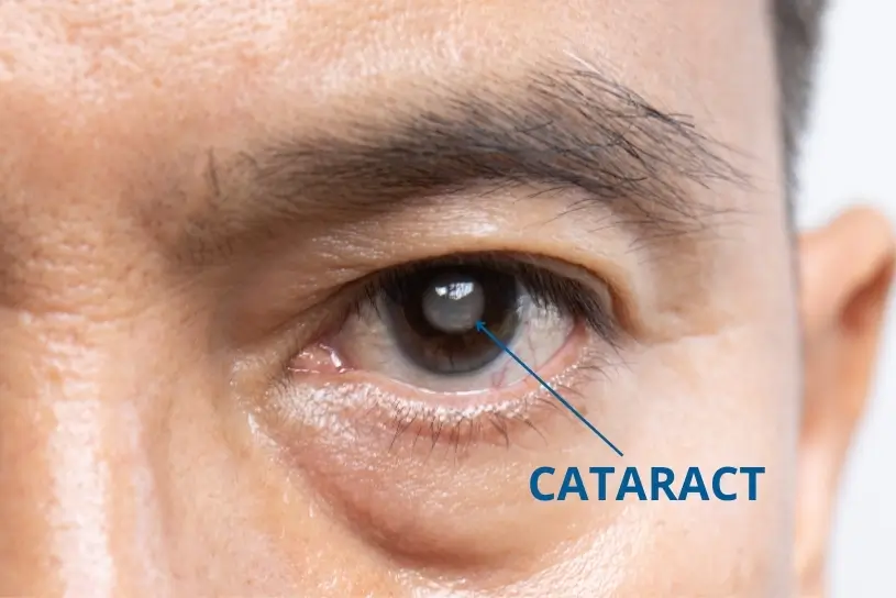Cataract Eye