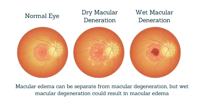 Age Related Macular Degeneration Vs Macular Edema