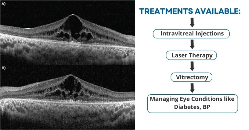 Treatment Options For Cystoid Macular Edema