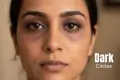 Dark circles