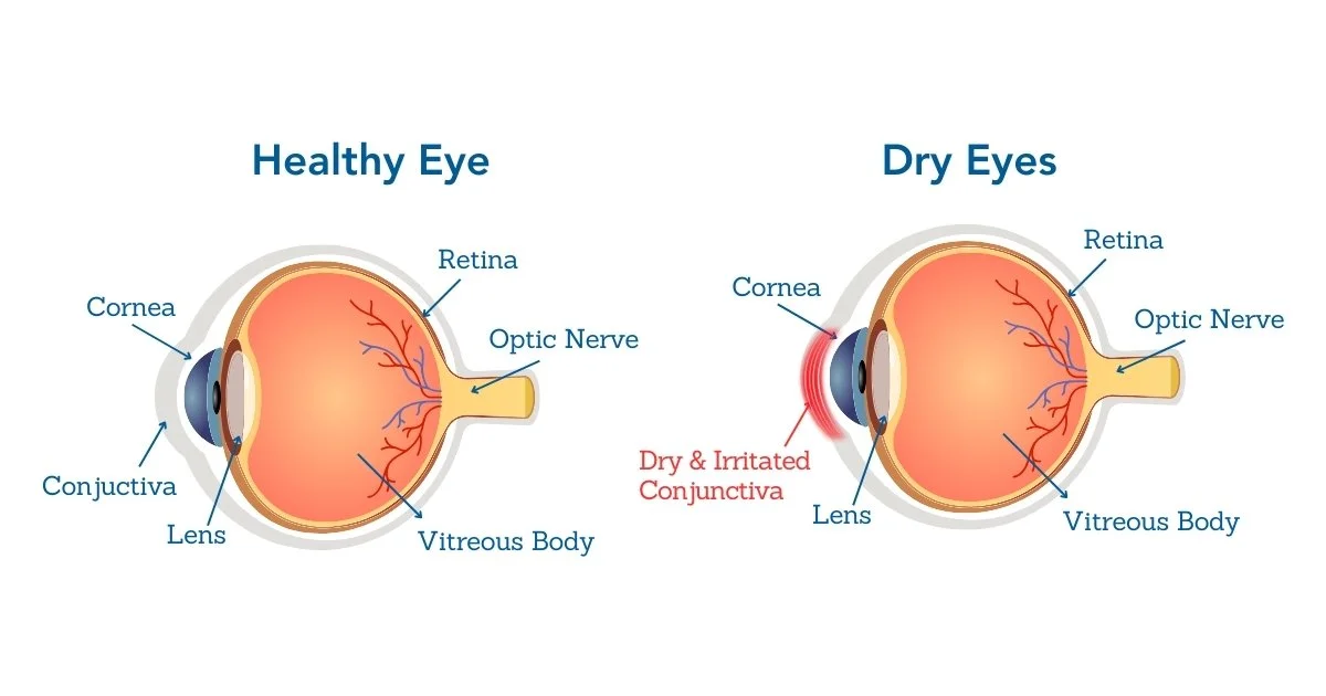Dry Eyes Retina