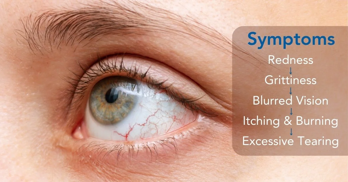 Symptoms Of Dry Eyes