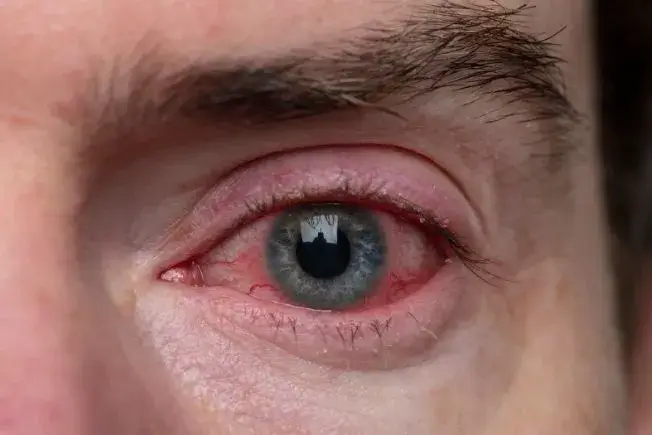 What is eye flu