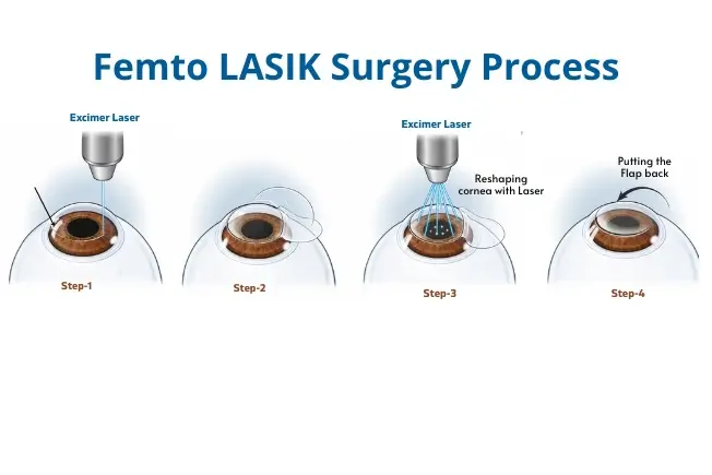 Steps of femto lasik