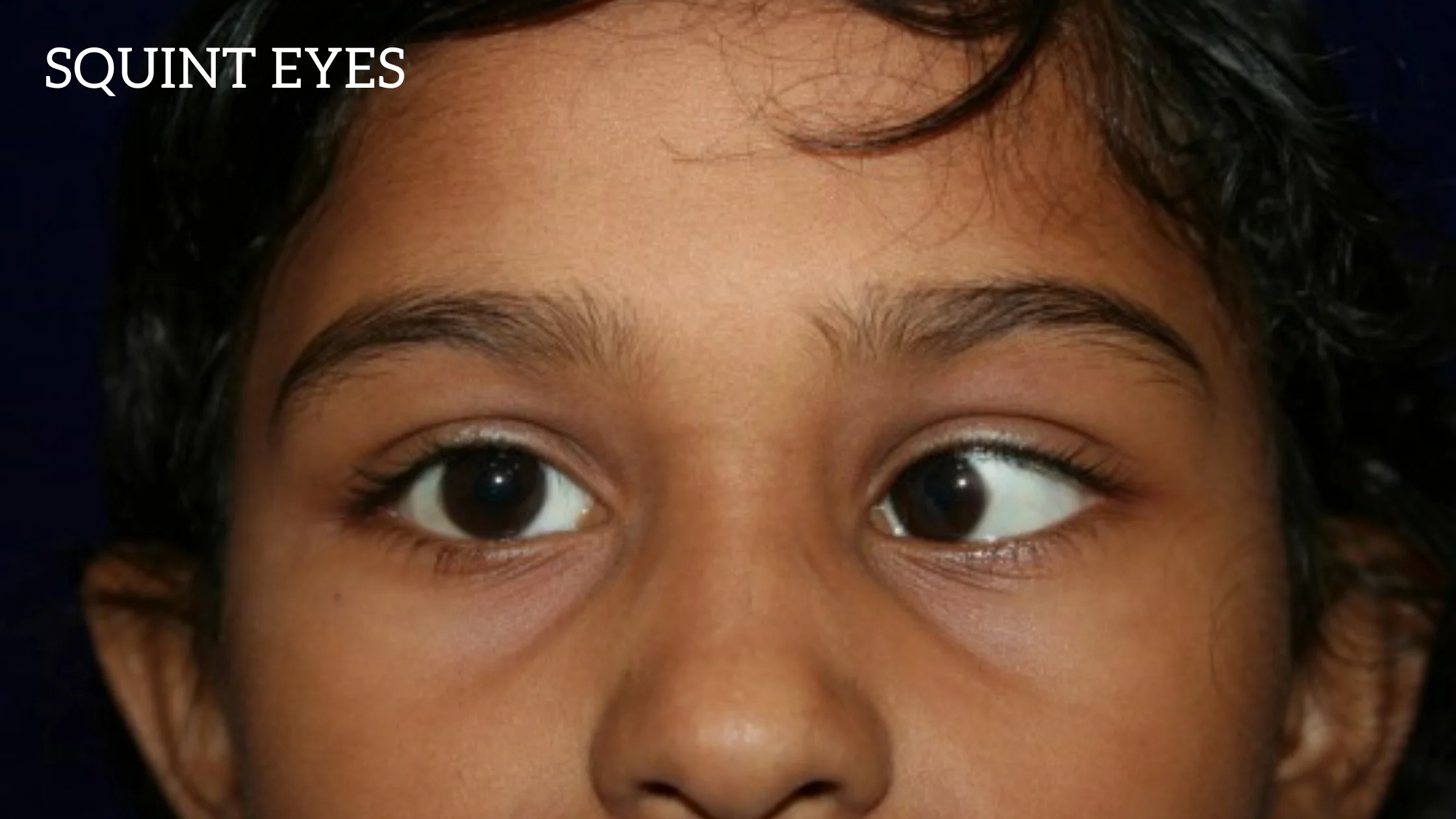 Eye Problems In Special Child