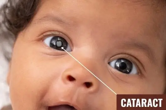 Cataract surgery delhi