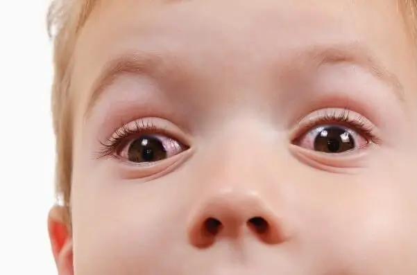 Eye allergy in kids