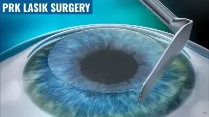 PRK lasik surgery delhi