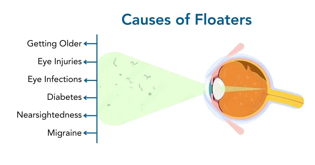 What causes Floaters?