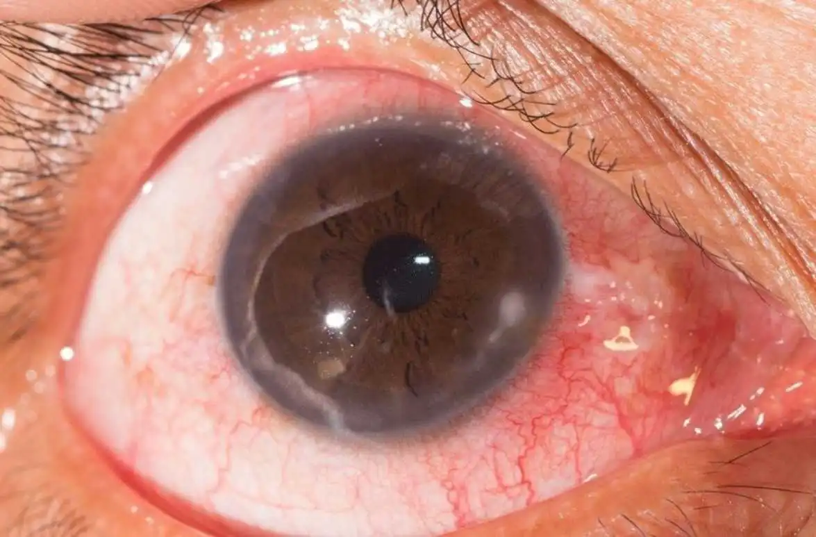 Fungal Keratitis Treatment