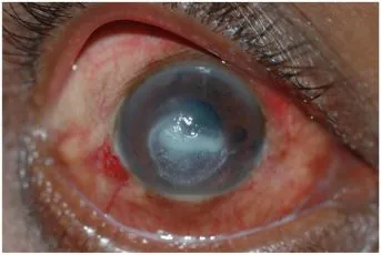 symptoms-of-fungal-keratitis