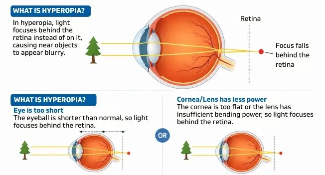 Hyperopia Meaning