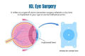 ICL eye surgery