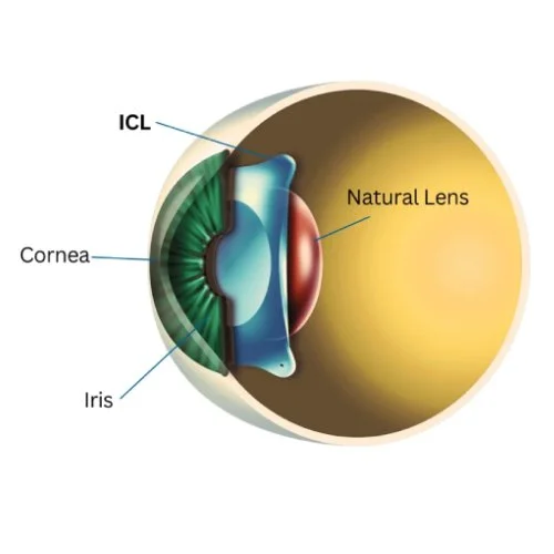 ICL Surgery in Delhi is Revolutionizing Vision Correction