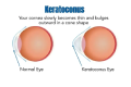 what is keratoconus