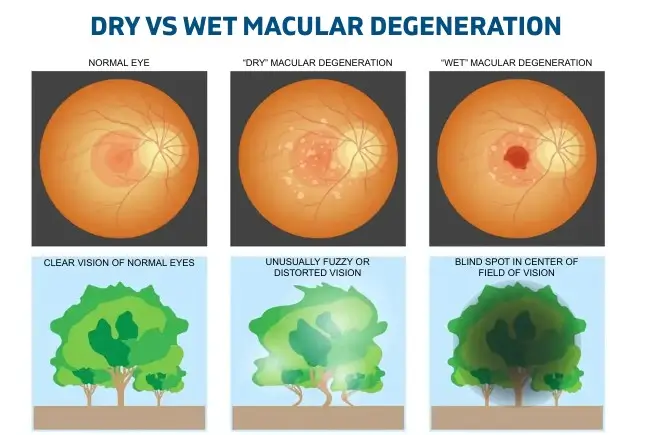 Dry vs. Wet AMD