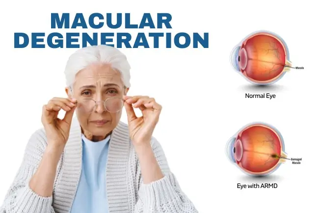 Macular Degeneration Treatment in Delhi
