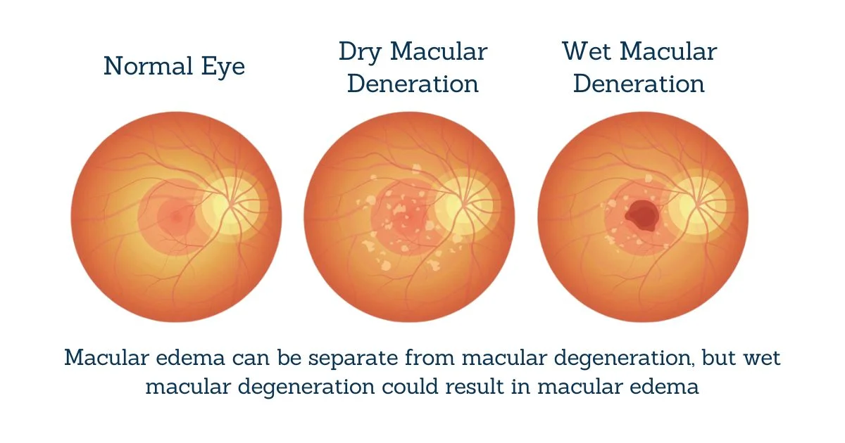 Age-Related Macular Degeneration Vs Macular Edema
