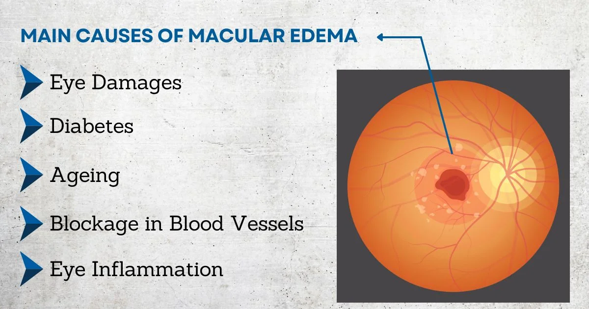 Causes of Cystoid Macular Edema