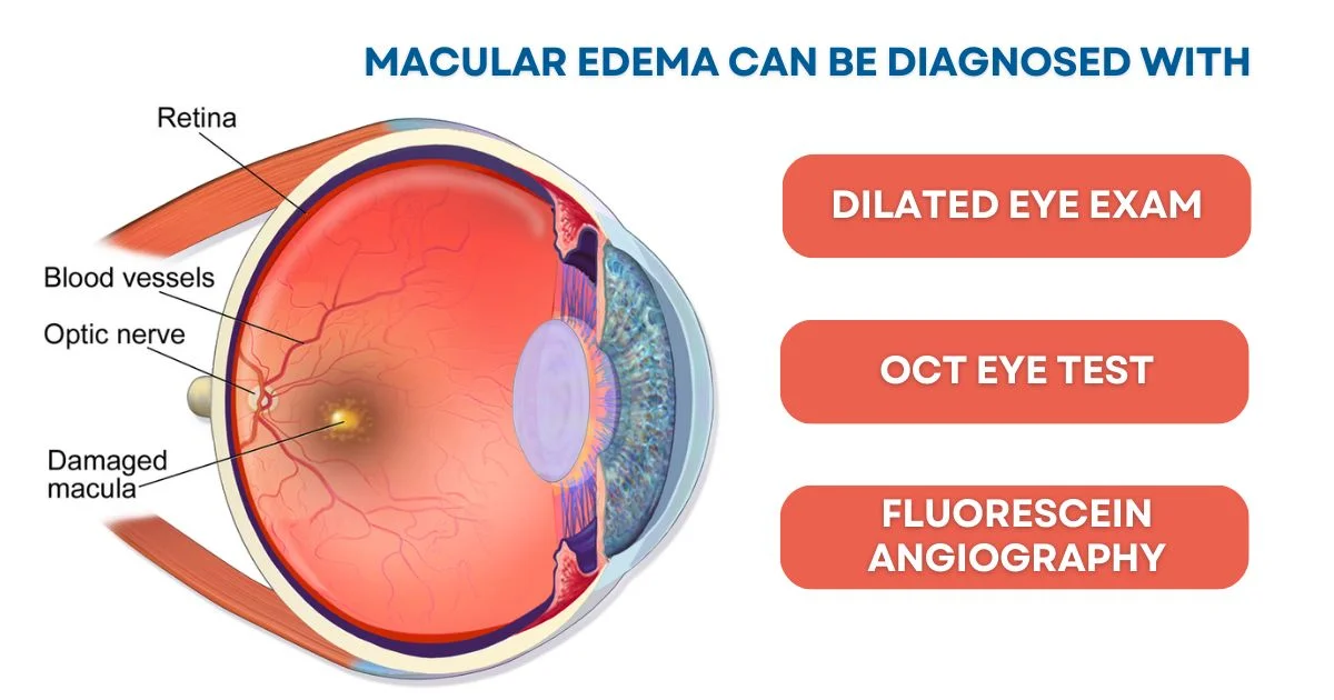 Diagnosing Cystoid Macular Edema