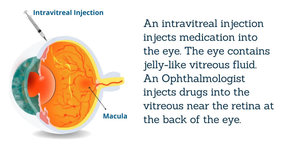 Intravitreal Injections in Macular Edema Treatment