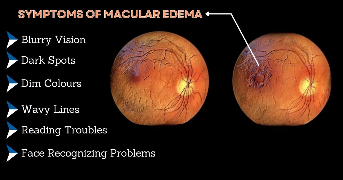 Symptoms of Cystoid Macular Edema
