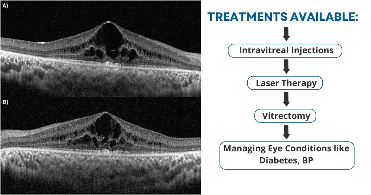 Treatment options for Cystoid Macular Edema