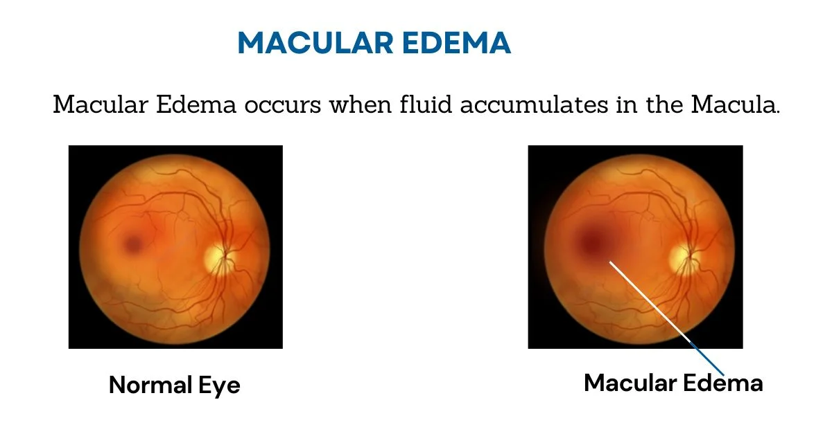 What is Cystoid Macular Edema