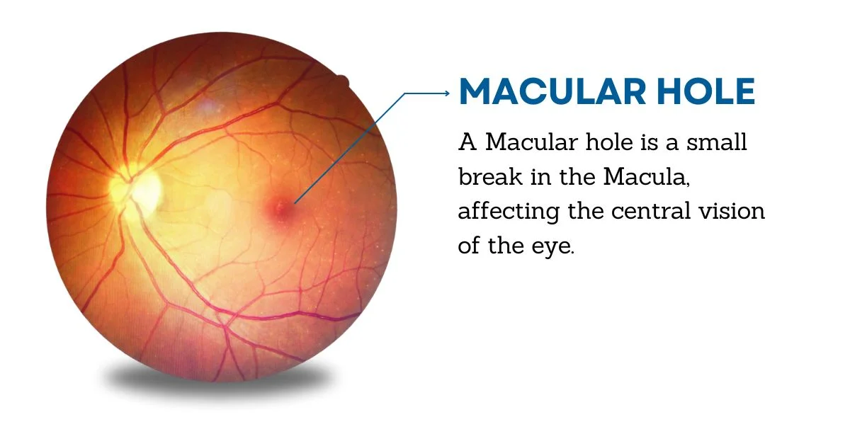 Macular Hole  and Tear