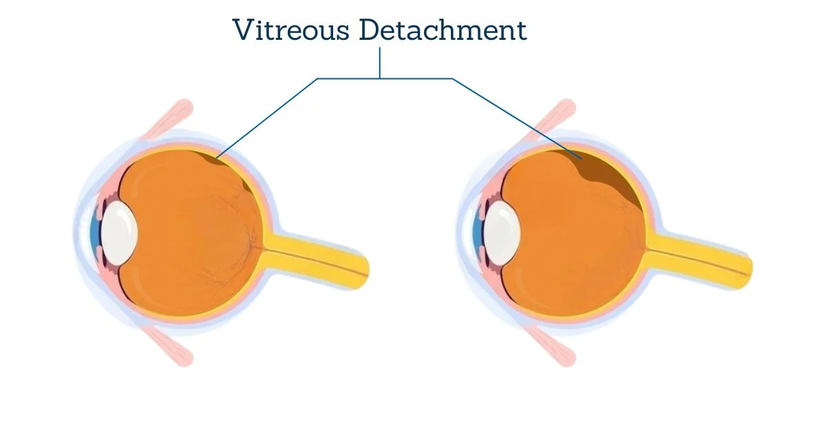 Vitreous Detachment in Macular Hole