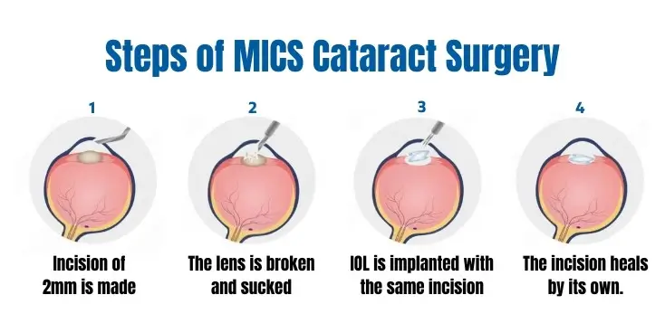 Steps of MICS cataract surgery