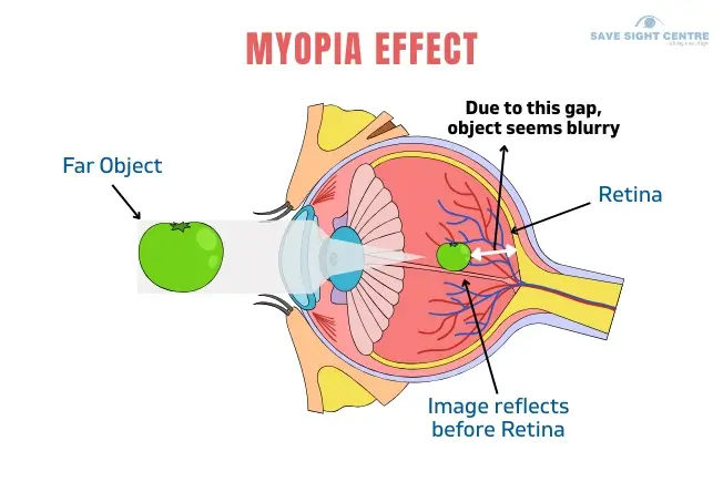 What Is Myopia